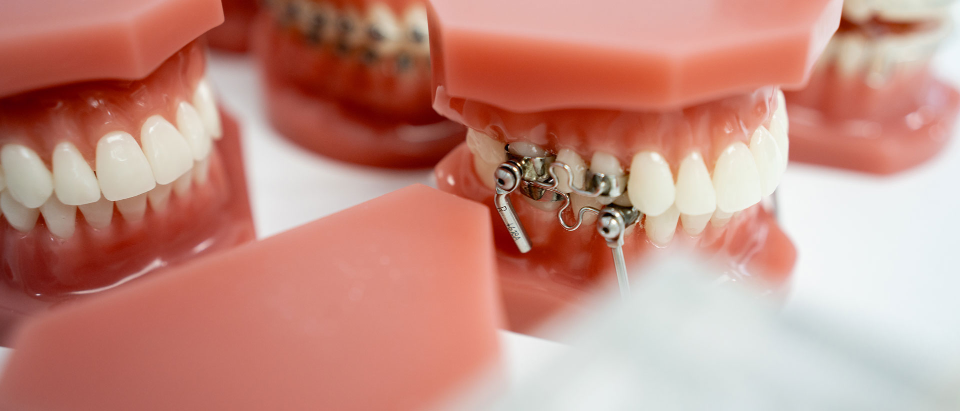 Metalen beugel voor orthodontische behandeling bij Ortho Nieuwegein